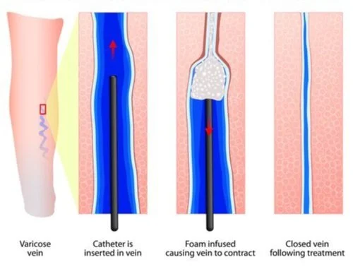 Ultrasound-guided foam sclerotherapy.