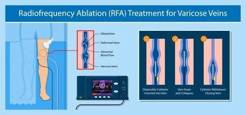 Radiofrequency ablation of a vein, performed under ultrasound guidance.