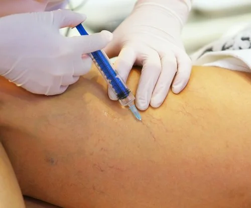 Visually guided injection of spider veins.